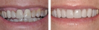 Old crowns with lots of gums showing treated by orthodontist to intrude teeth followed  by new crown restorations replacing old crowns and matching veneers on discolored natural teeth.